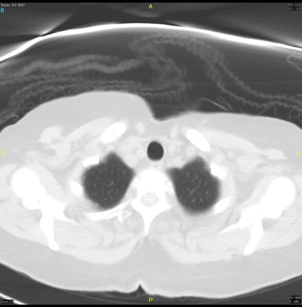 File:Breast primary with lung and bone metastases (Radiopaedia 40620-43228 Axial lung window 6).jpg