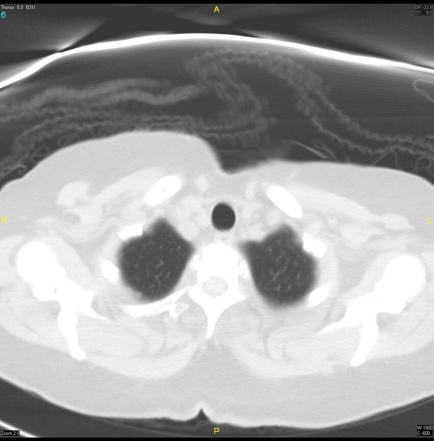 Breast primary with lung and bone metastases (Radiopaedia 40620-43228 Axial lung window 6).jpg