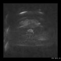 Broad ligament fibroid (Radiopaedia 49135-54241 Axial DWI 7).jpg