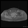 Broad ligament fibroid (Radiopaedia 49135-54241 Axial T1 fat sat 21).jpg