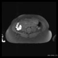 Broad ligament fibroid (Radiopaedia 49135-54241 Axial T1 fat sat 4).jpg