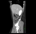 Broad ligament hernia (Radiopaedia 63260-71832 C 12).jpg