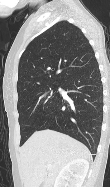 File:Bronchial atresia (Radiopaedia 73677-84470 Sagittal lung window 17).jpg