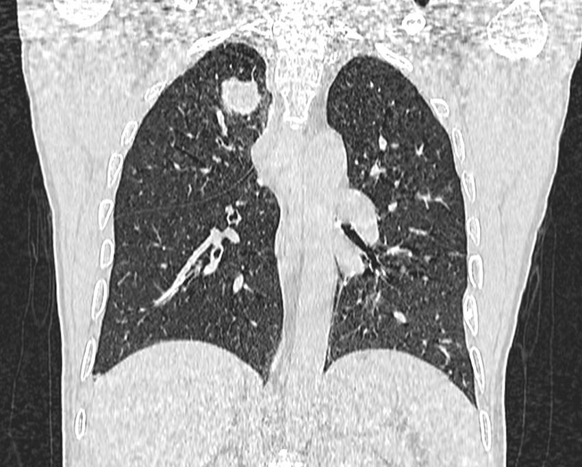 Bronchogenic carcinoma with superior vena cava syndrome (Radiopaedia 36497-38054 Coronal lung window 61).jpg
