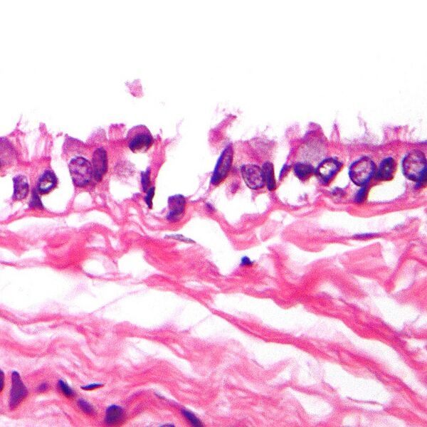 File:Bronchogenic cyst (histology) (Radiopaedia 8498-9315 B 1).jpg