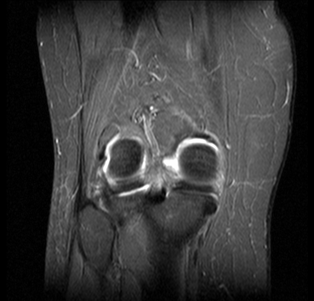 File:Bucket handle tear - medial meniscus (Radiopaedia 24900-25163 Coronal T2 fat sat 1).png