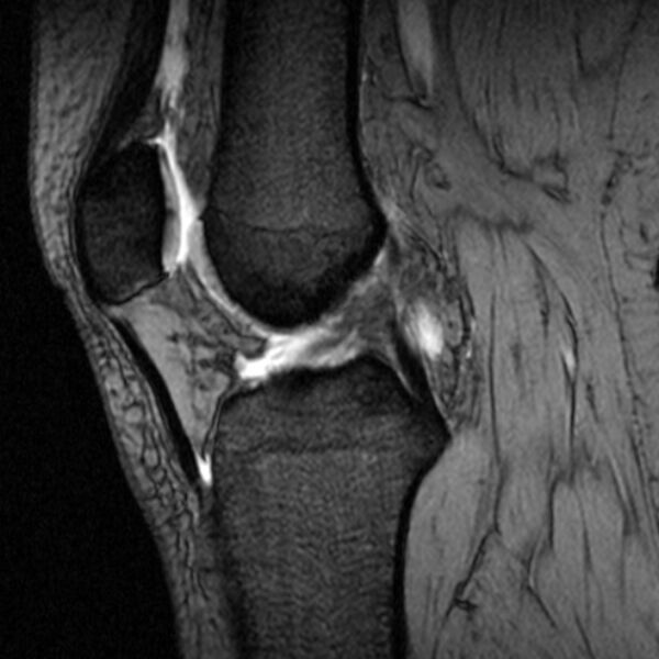 File:Bucket handle tear - medial meniscus (Radiopaedia 79028-91942 D 12).jpg