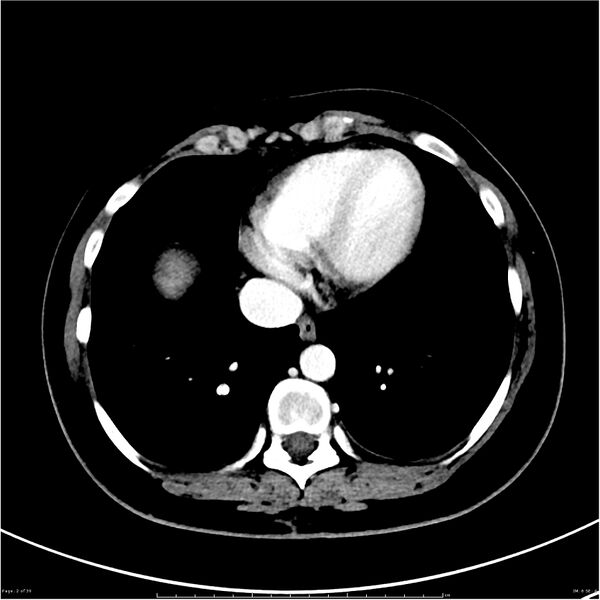 File:Budd-Chiari syndrome (Radiopaedia 27929-28177 Axial liver window 2).JPG