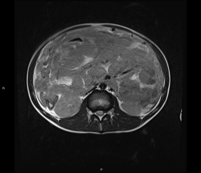 File:Burkitt lymphoma (bowel) (Radiopaedia 68839-78557 Axial T2 29).jpg