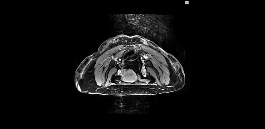 Buttock filler complications (Radiopaedia 63497-72115 Axial T1 C+ 2).jpg