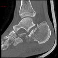 Calcaneal fracture and associated spinal injury (Radiopaedia 17896-17656 Sagittal bone window 3).jpg