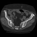 Calcified fibroids (Radiopaedia 16853-16579 non-contrast 1).jpg