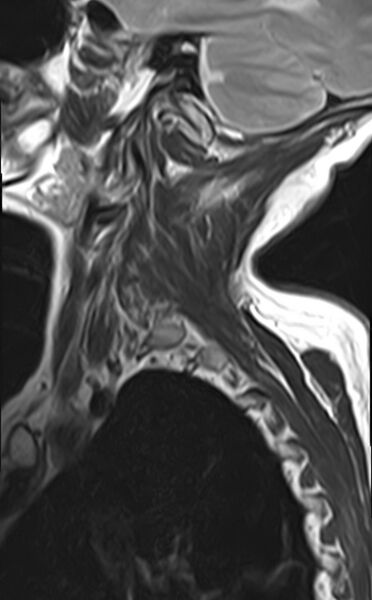 File:Calcified meningioma - cervical canal (Radiopaedia 70136-82468 Sagittal T2 1).jpg