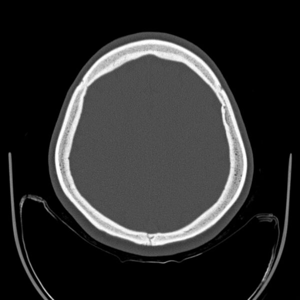 File:Calvarial osteoma (Radiopaedia 36520-38079 Axial bone window 82).jpg
