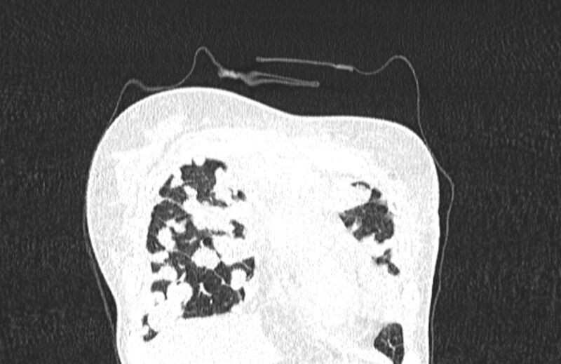 File:Cannonball metastases from breast cancer (Radiopaedia 91024-108569 Coronal lung window 18).jpg