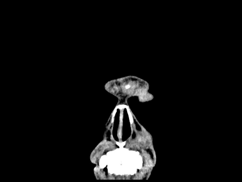 File:Capillary hemangioma of the orbit (Radiopaedia 44610-48358 B 7).jpg