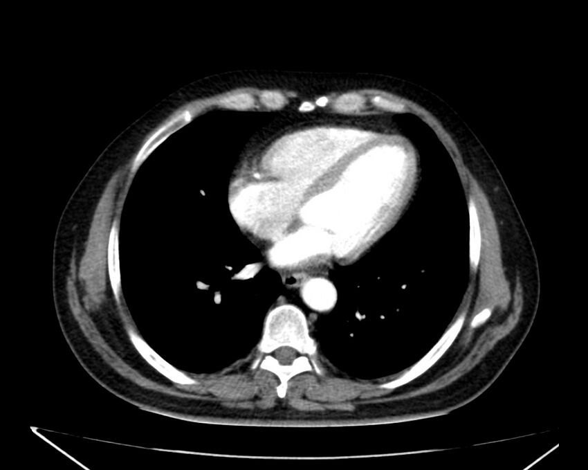 Carcinoid tumor with hepatic metastases (Radiopaedia 22651-22670 B 1).jpg