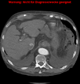 Cardiac perforation following transcatheter aortic valve implantation (Radiopaedia 23714-23863 A 19).png