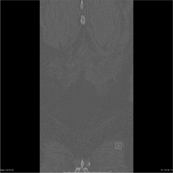 File:Cardiac trauma (Radiopaedia 32874-33858 Coronal bone window 110).jpg