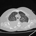Cardiogenic pulmonary edema (Radiopaedia 29213-29609 Axial lung window 19).jpg
