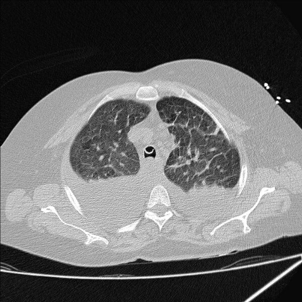File:Cardiogenic pulmonary edema (Radiopaedia 29213-29609 Axial lung window 19).jpg
