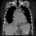 Cardiogenic pulmonary edema (Radiopaedia 29213-29609 Coronal non-contrast 19).jpg