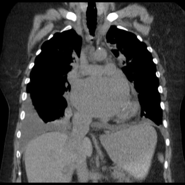 File:Cardiogenic pulmonary edema (Radiopaedia 29213-29609 Coronal non-contrast 19).jpg