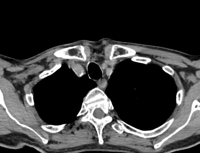 Carotid artery pseudoaneurysm (Radiopaedia 84030-99259 Axial non-contrast 53).jpg
