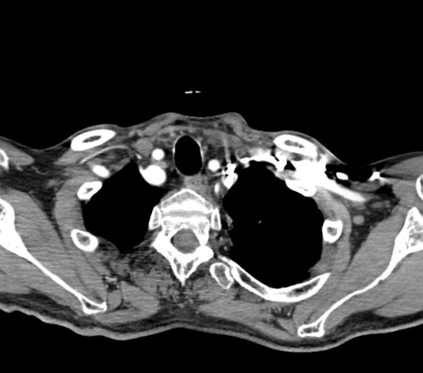 Carotid artery pseudoaneurysm (Radiopaedia 84030-99259 C 75).jpg