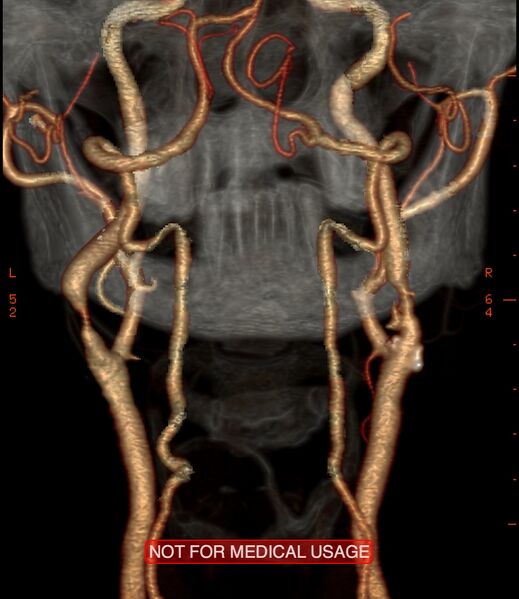 File:Carotid artery stenosis (Radiopaedia 28786-29086 A 8).jpg