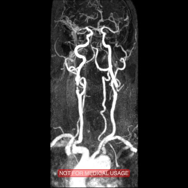 File:Carotid artery stenosis (Radiopaedia 28786-29087 3D MRA 6).jpg