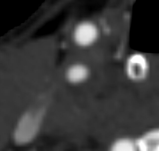 File:Carotid near-occlusion (Radiopaedia 85304-100887 M 48).jpg