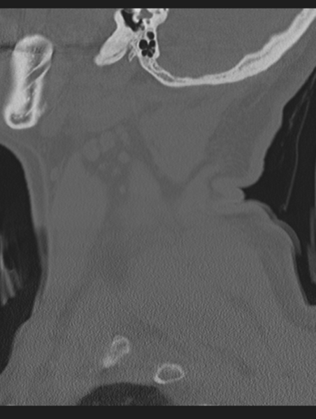 File:Cavernoma of cervical cord (Radiopaedia 50838-56346 Sagittal bone window 10).png