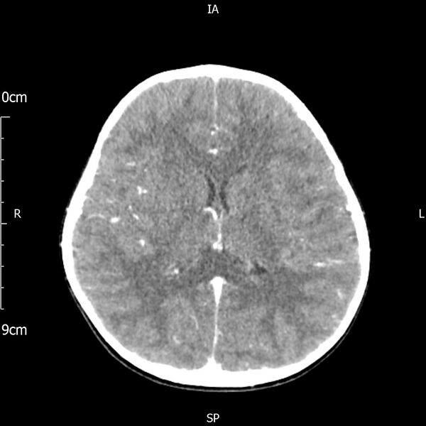 File:Cavernous sinus thrombosis (Radiopaedia 79414-92510 Axial Brain 115).jpg