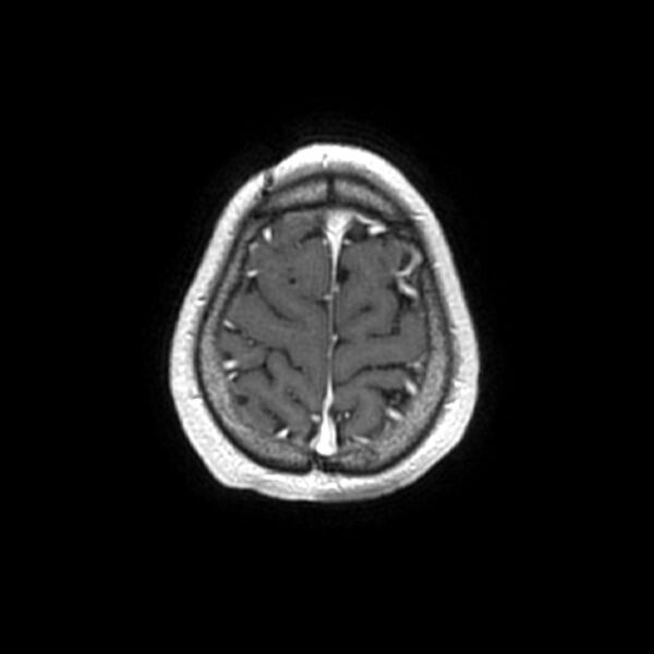 File:Central neurocytoma (Radiopaedia 67618-77021 Axial T1 C+ 27).jpg