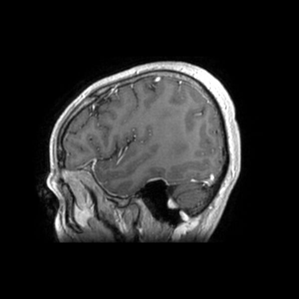 File:Central neurocytoma (Radiopaedia 67618-77021 Sagittal T1 C+ 5).jpg