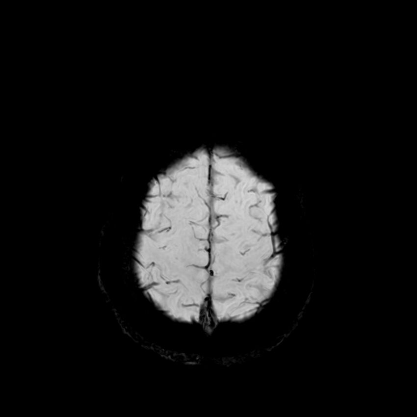 Central neurocytoma (Radiopaedia 79320-92380 Axial SWI 124).jpg