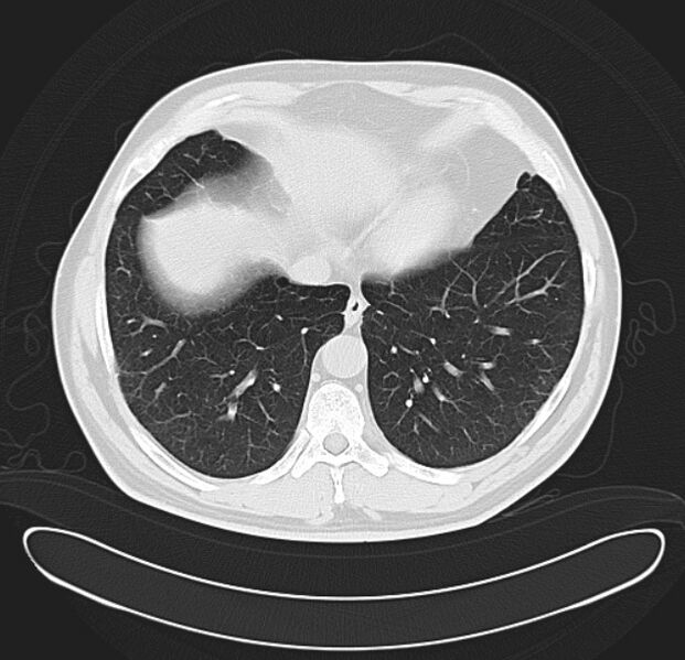 File:Centrilobular pulmonary emphysema (Radiopaedia 26808-26971 C 34).jpg