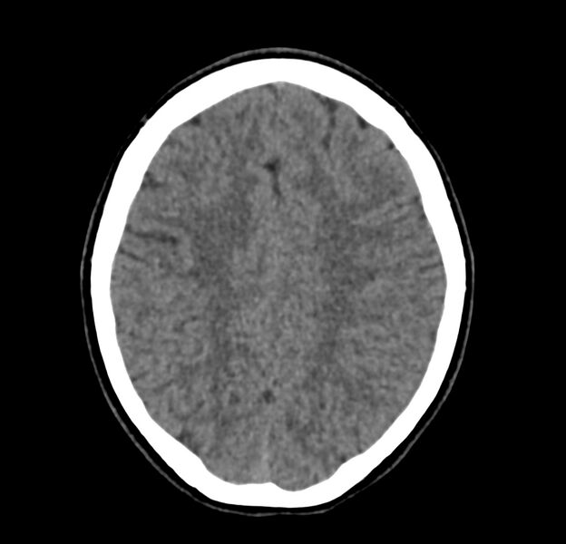 File:Cerebellar agenesis (Radiopaedia 30203-30817 Axial non-contrast 35).jpg