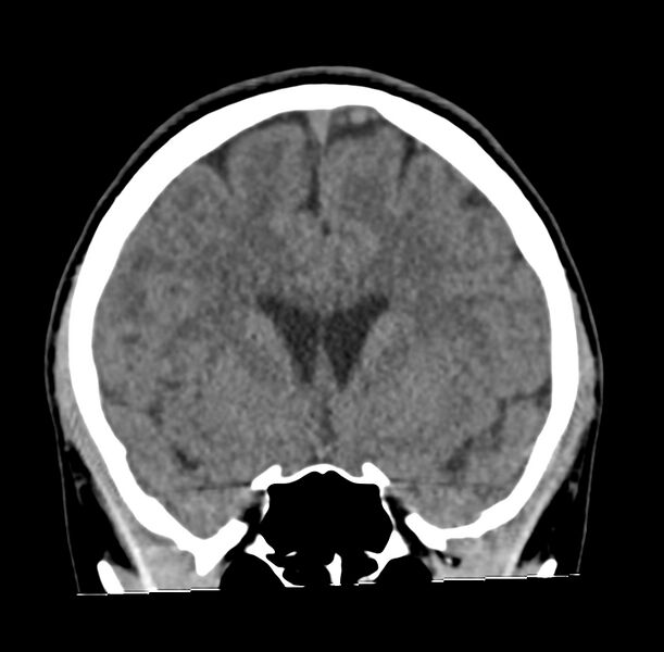 File:Cerebellar agenesis (Radiopaedia 30203-30817 Coronal non-contrast 11).jpg