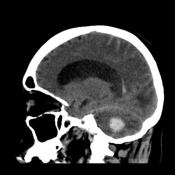 File:Cerebellar hemorrhage causing obstructive hydrocephalus (Radiopaedia 33989-35207 B 19).jpg