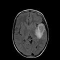 Cerebral abscess post cardiac surgery (Radiopaedia 27244-27420 Axial FLAIR 12).jpg