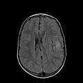 Cerebral abscess post cardiac surgery (Radiopaedia 27244-27420 Axial FLAIR 16).jpg