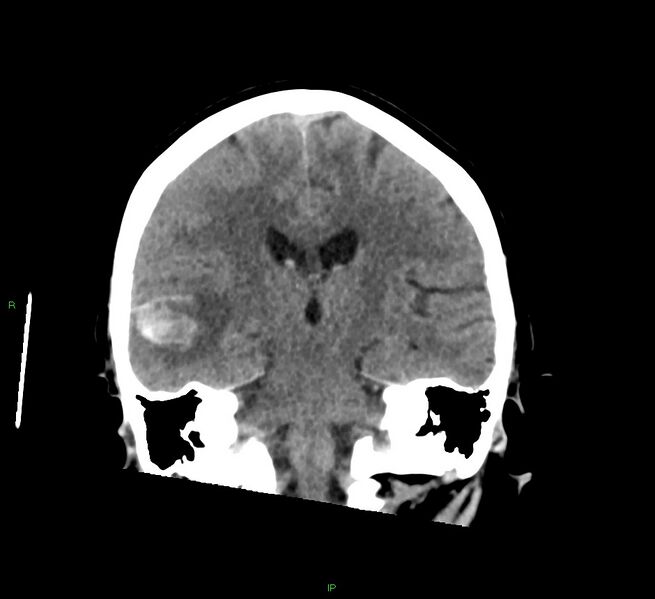 File:Cerebral amyloid angiopathy-associated lobar intracerebral hemorrhage (Radiopaedia 58378-65516 Coronal non-contrast 29).jpg
