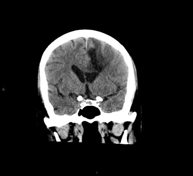 File:Cerebral amyloid angiopathy-associated lobar intracerebral hemorrhage (Radiopaedia 58529-65681 Coronal non-contrast 42).jpg