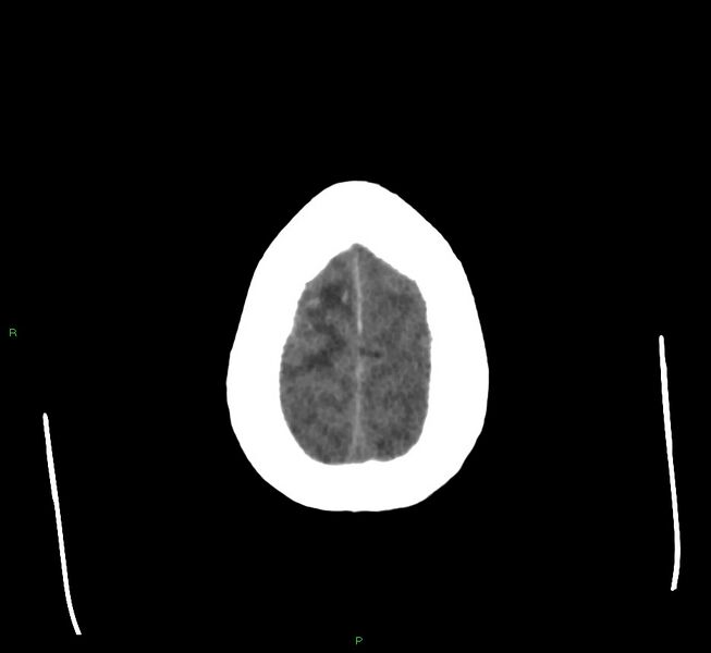 File:Cerebral amyloid angiopathy-associated lobar intracerebral hemorrhage (Radiopaedia 58560-65723 Axial non-contrast 8).jpg