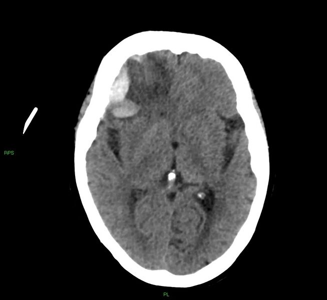 File:Cerebral amyloid angiopathy-associated lobar intracerebral hemorrhage (Radiopaedia 58569-65734 Axial non-contrast 34).jpg