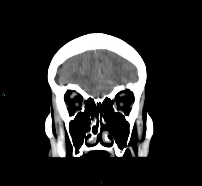 File:Cerebral amyloid angiopathy-associated lobar intracerebral hemorrhage (Radiopaedia 58751-65972 Coronal non-contrast 49).jpg