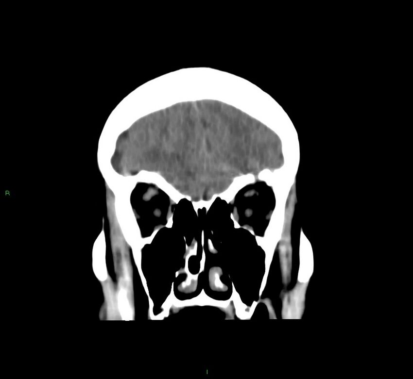 Cerebral amyloid angiopathy-associated lobar intracerebral hemorrhage (Radiopaedia 58751-65972 Coronal non-contrast 49).jpg