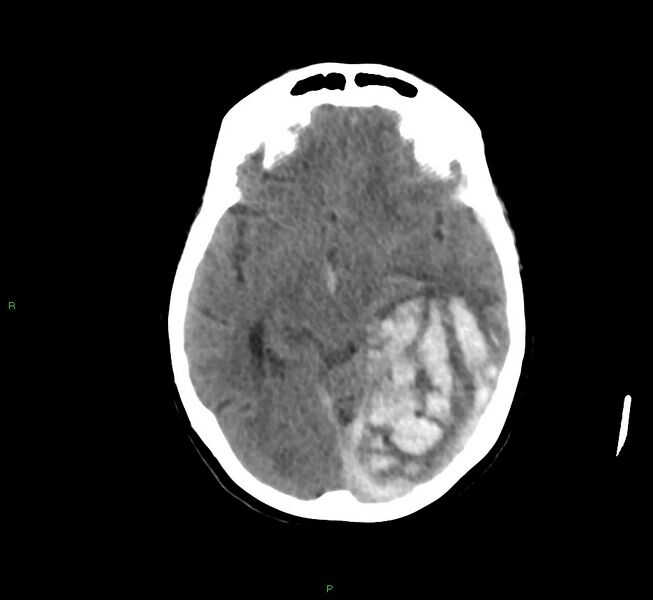 File:Cerebral amyloid angiopathy-associated lobar intracerebral hemorrhage (Radiopaedia 58754-65975 Axial non-contrast 37).jpg
